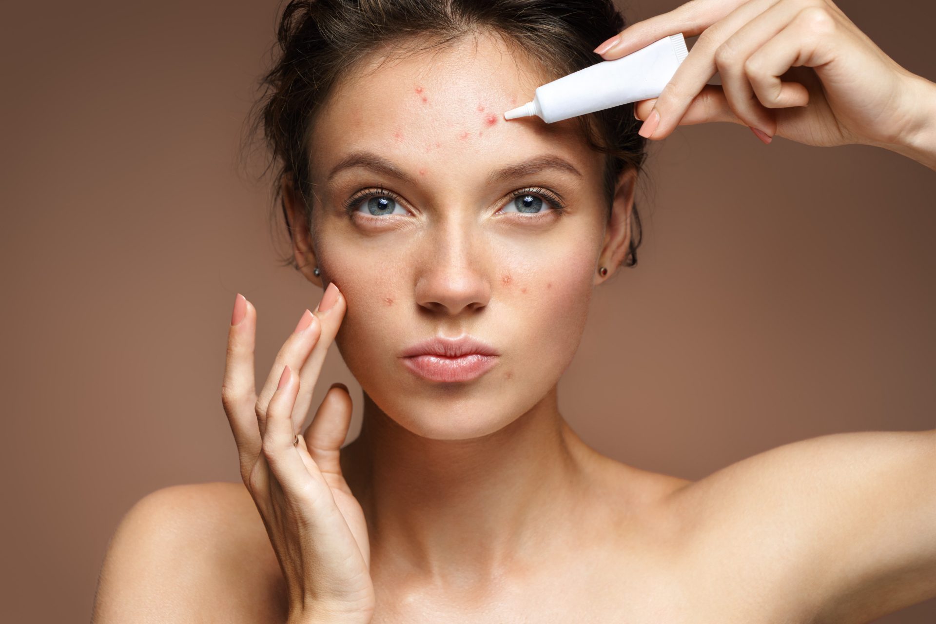 7 Causes of Adult Acne and Ways to Treat It