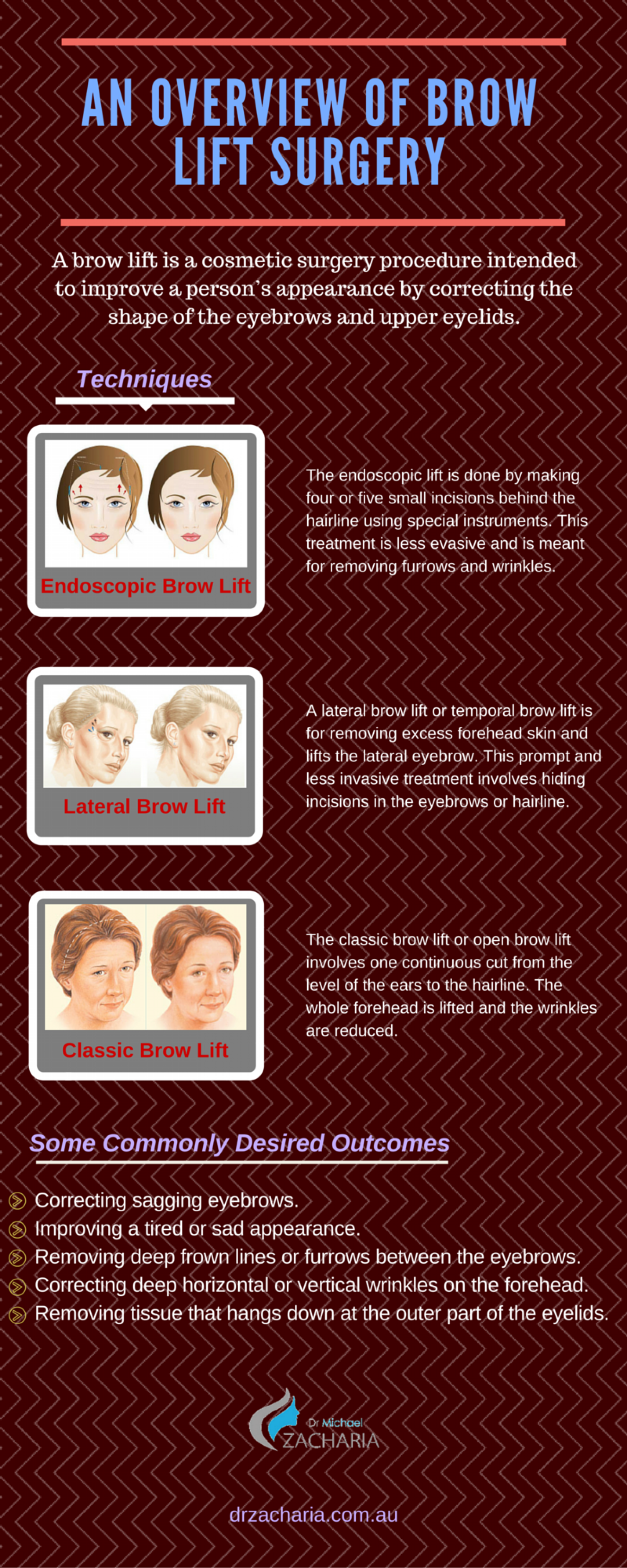 An Overview Of Brow Lift Surgery