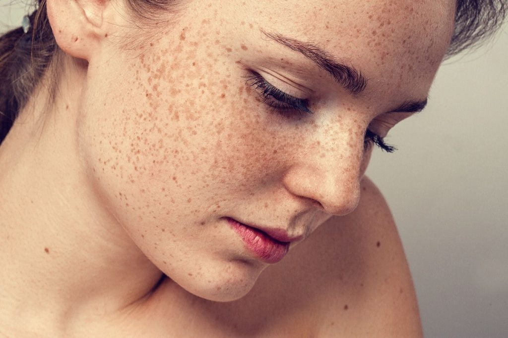 10 Best Ways To Get Rid Of Freckles 5895